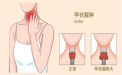 什么保险可以保甲状腺，可以保甲状腺的保险_1